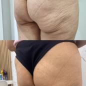 Harmonização dos Glúteos em Jundiaí - GLÚTEOS POWER LIFT