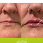 Preenchimento labial