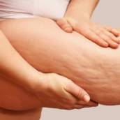 Tratamento para Lipedema - Redução de Desconforto e Melhora na Qualidade de Vida em Avaré/SP