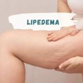 Tratamento para Lipedema (Gordura nas pernas)