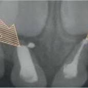 Tratamento de canal em dente decíduo