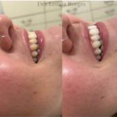 Clareamento dental 