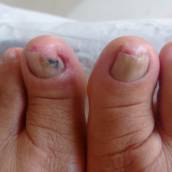 Tratamento de Onicomicose em Franca: Soluções Eficazes - Clínica Roseli Rosendo