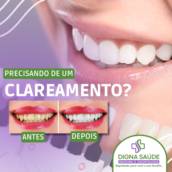  Clareamento no Consultório – Sorriso Brilhante com Segurança – Excelência da Digna Saúde – Ribeirão Preto/SP