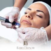 Microagulhamento Facial em Itapetininga
