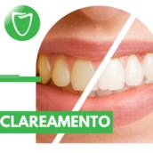 Clareamento profissional para dentes em Itapetininga