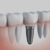 Implantes Dentários Porcelana - Beleza e Durabilidade - Macatuba