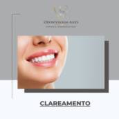 Fazer Clareamento no dente em Itapetininga