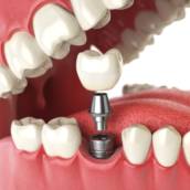 Implantes Dentários – Sorriso Completo e Confiança em Lençóis Paulista/SP