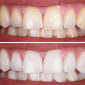 Clareamento Dentário – Sorriso Mais Branco e Confiante em Lençóis Paulista/SP