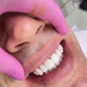 Sorriso Perfeito com Resina de Qualidade em Avaré - SP