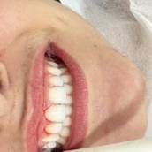 Sorriso Harmônico com Gengivoplastia em Avaré - SP