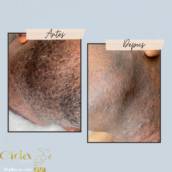 Depilação Barba