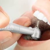 Sorriso Saudável e Livre de Tártaro – Limpeza Dental Profissional em Lençóis Paulista