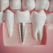 Implantes Dentários Avançados em Avaré – Conforto, Estética e Segurança