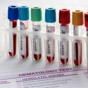 Exames de Hematologia 