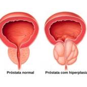 Tratamento de Hiperplasia de Próstata (HPB) em Juiz de Fora