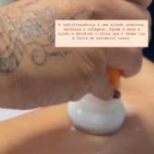 Radiofrequência em Novo Gama – Rejuvenescimento e Firmeza para Sua Pele