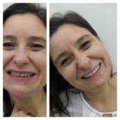 Facetas Dentais em Hortolândia – Odonto Los Angeles