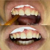 Reabilitação Oral em Hortolândia – Odonto Los Angeles