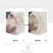 Remoção de Verrugas e Sinais na Pele em Goiatuba – Estética e Segurança