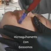 Microagulhamento em São Manuel – Rejuvenescimento com Resultados Visíveis