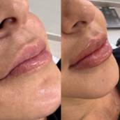  BIOLIPS em Jundiaí