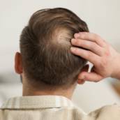Tratamento para Calvície em Santa Helena de Goiás – Saúde e Autoconfiança