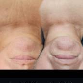 Proxy Enzima em Ourinhos – Rejuvenescimento Facial