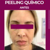 Peeling Químico – Pele Renovada e Radiante no Rio de Janeiro