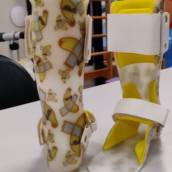 Órtese Suropodálica Fixa Infantil Personalizada - Conforto e Correção em Ribeirão Preto/SP
