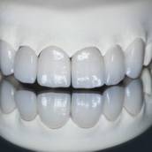 Facetas e Lentes: Sorriso Estético e Natural em Uberlândia/MG