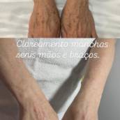 Clareamento de Manchas – Espaço Vip Estética