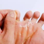 Ressecamento Plantar Em Franca SP Com Tratamento