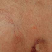 Hematoma Subungueal Em Franca SP Com Avaliação
