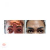 Botox em Duque de Caxias, RJ - Rejuvenescimento Natural