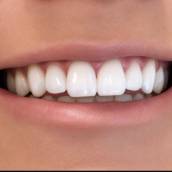 Clareamento em São José dos Campos: Sorriso Branco