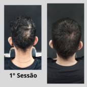 Micropigmentação Capilar