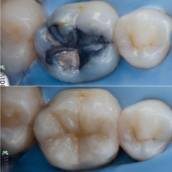 Restauração de Dentes Posteriores em Francisco Beltrão