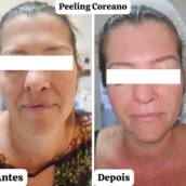 Peeling Coreano em Avaré – Centro de Estética Boa Forma