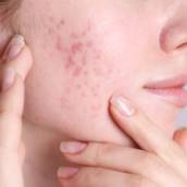 Tratamento para Acne