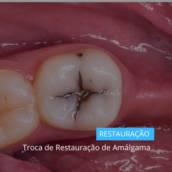 Troca de Restauração de Amálgama em Itapetininga
