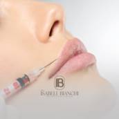 Hidratação Labial com Ácido Hialurônico e Efeito Gloss em Itapetininga 
