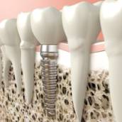 Implantes dental