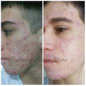 Tratamento facial pele com acne