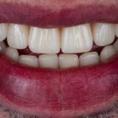 Perder dentes não mexe apenas com a boca... mexe com a vida interia. Comer o que gosta deixa de ser prazer, sorrir vira insegurança e até momentos simples do dia a dia parecem perder a graça. Muitas vezes, o que pesa não é só a dificuldade, mas também a vontade de voltar a se sentir completo.
É por isso que o protocolo com implantes pode transformar. Ele devolve dentes fixos, firmes e com aspecto naturais. 
Traz de volta a segurança para sorrir sem medo.
Recupera além da estética. Ganha autoestima.
Com o protocolo, não é só a boca que se reconstrói. É a liberdade, a alegria e a confiança de viver plenamente em cada momento. 