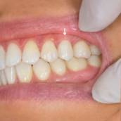 Coroa de Porcelana / Prótese Fixa em São José dos Campos: Sorriso Natural