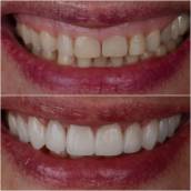 Sabe aquela pessoa que quando sorri a gengiva aparece em excesso? A Cirurgia Plástica Gengival harmoniza o sorriso. Ao corrigir o contorno da gengiva, é possível equilibrar a estética branca dos dentes com a estética vermelha da gengiva, revelando dentes proporcionais e uma linha do sorriso natural e saudável. 
Também podemos lançar mão dessa técnica para pequenas correções de assimetrias gengivais ou ainda como uma preparação estética para facetas, lentes ou restaurações.
Mais do que transformar a aparência, a cirurgia plástica gengival recupera a confiança para sorrir plenamente.