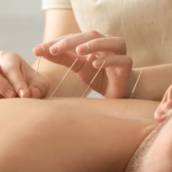 Acupuntura/Auriculoterapia