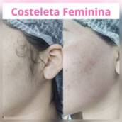 Depilação Costeleta Feminina 